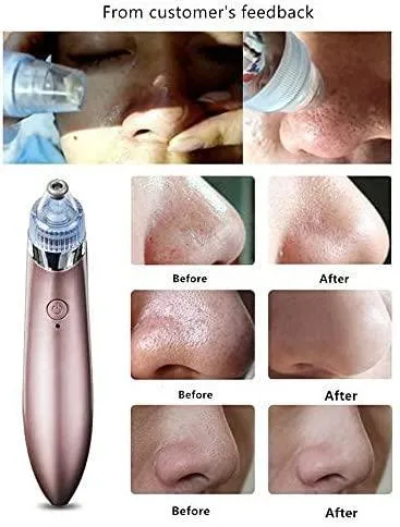 Acne pore cleaner Vacuum negative pressure easy pimple removing - XN-8030